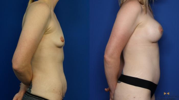 Before & After Tummy Tuck Case 378 Right Side View in Fort Worth & Arlington, Texas