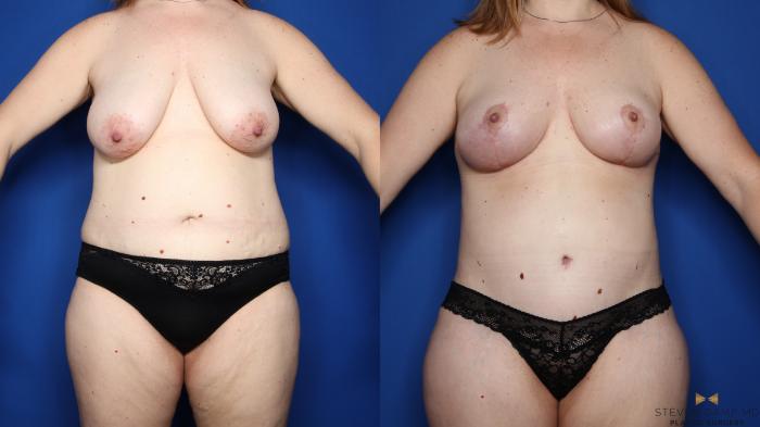 Before & After Liposuction Case 409 Front View in Fort Worth & Arlington, Texas