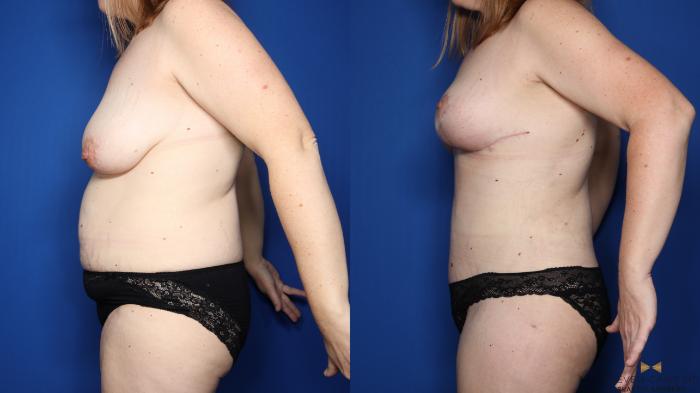 Before & After Tummy Tuck Case 409 Left Side View in Fort Worth & Arlington, Texas