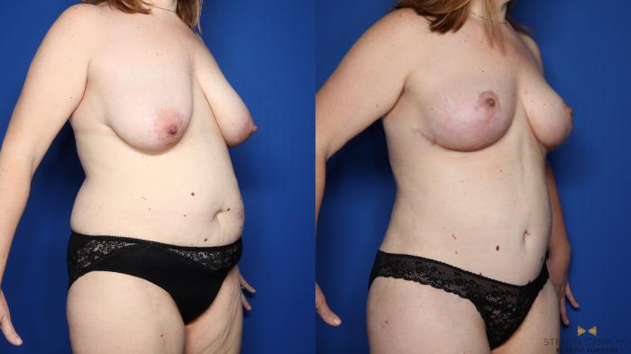 Before & After Tummy Tuck Case 409 Right Oblique View in Fort Worth & Arlington, Texas