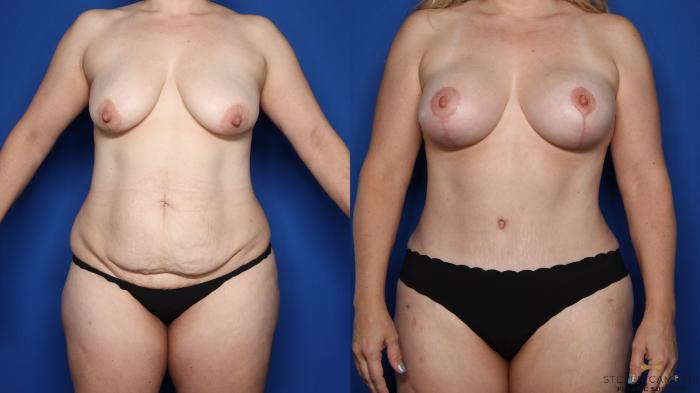 Before & After Liposuction Case 410 Front View in Fort Worth & Arlington, Texas