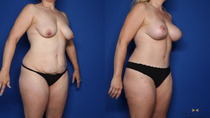 Before & After Mommy Makeover Case 410 Right Oblique View in Fort Worth & Arlington, Texas