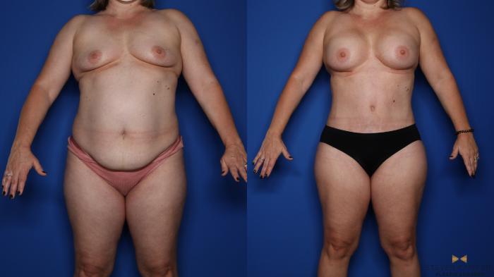 Before & After Mommy Makeover Case 422 Front View in Fort Worth & Arlington, Texas
