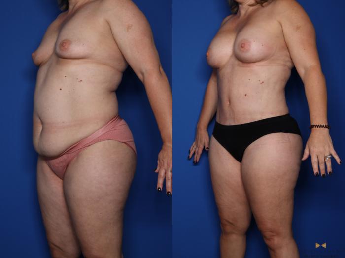 Before & After Tummy Tuck Case 422 Left Oblique View in Fort Worth & Arlington, Texas