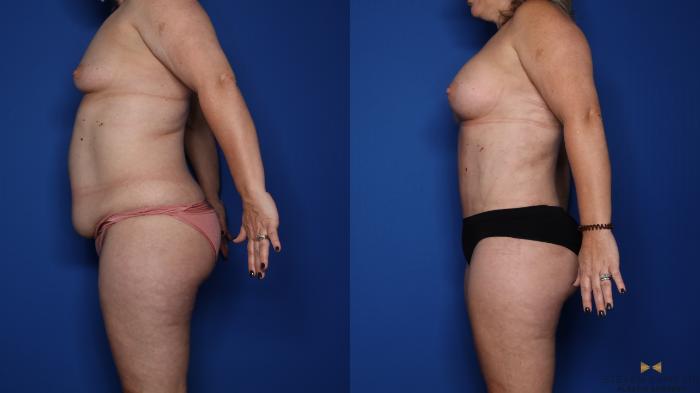 Before & After Mommy Makeover Case 422 Left Side View in Fort Worth & Arlington, Texas