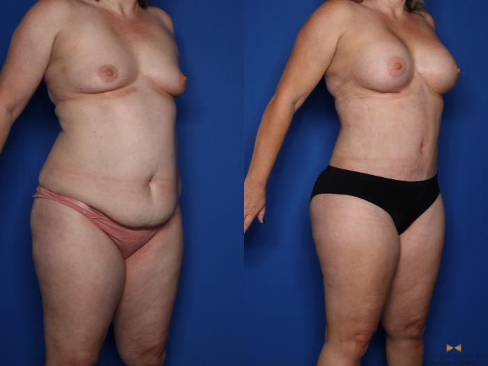 Before & After Tummy Tuck Case 422 Right Oblique View in Fort Worth & Arlington, Texas