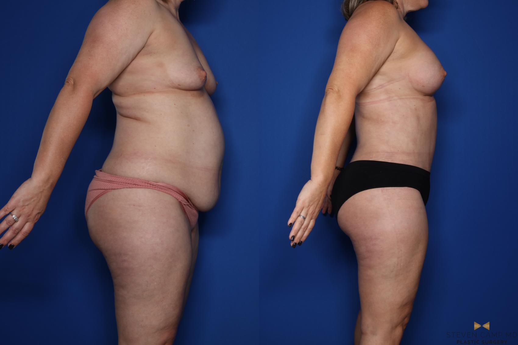 Before & After Liposuction Case 422 Right Side View in Fort Worth & Arlington, Texas