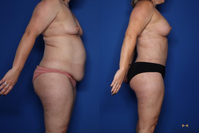 Before & After Tummy Tuck Case 422 Right Side View in Fort Worth & Arlington, Texas