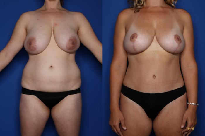Before & After Breast Reduction Case 434 Front View in Fort Worth & Arlington, Texas