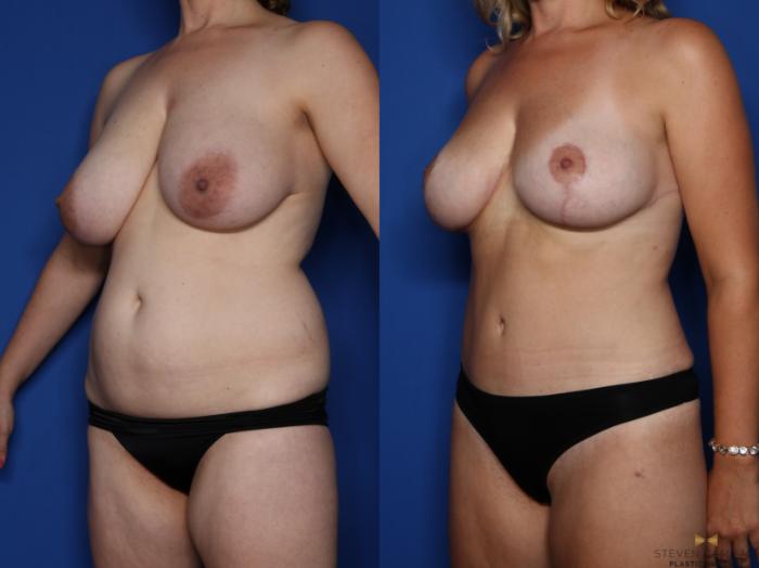 Before & After Breast Reduction Case 434 Left Oblique View in Fort Worth & Arlington, Texas