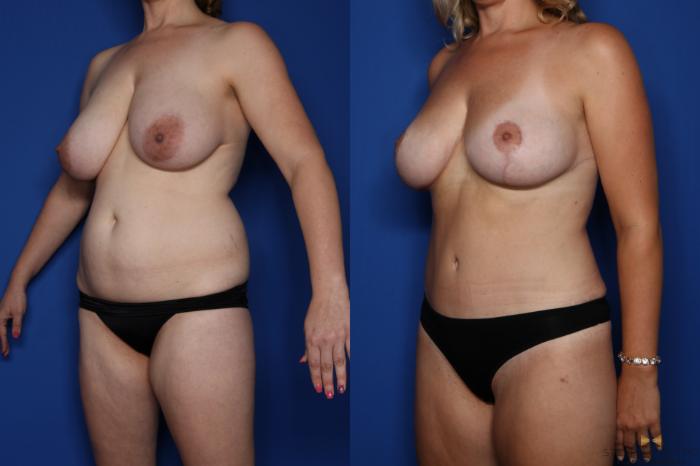 Before & After Tummy Tuck Case 434 Left Side View in Fort Worth & Arlington, Texas
