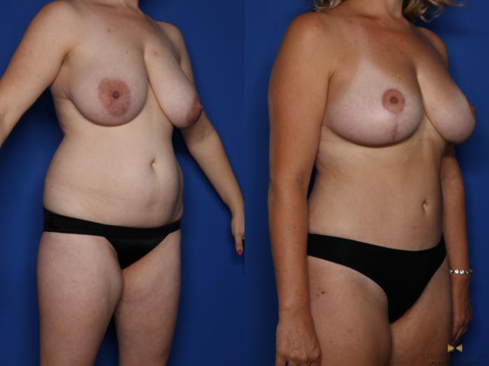 Before & After Tummy Tuck Case 434 Right Oblique View in Fort Worth & Arlington, Texas