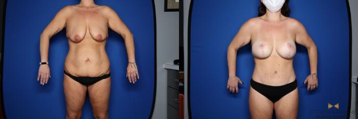 Before & After Tummy Tuck Case 438 Front View in Fort Worth & Arlington, Texas