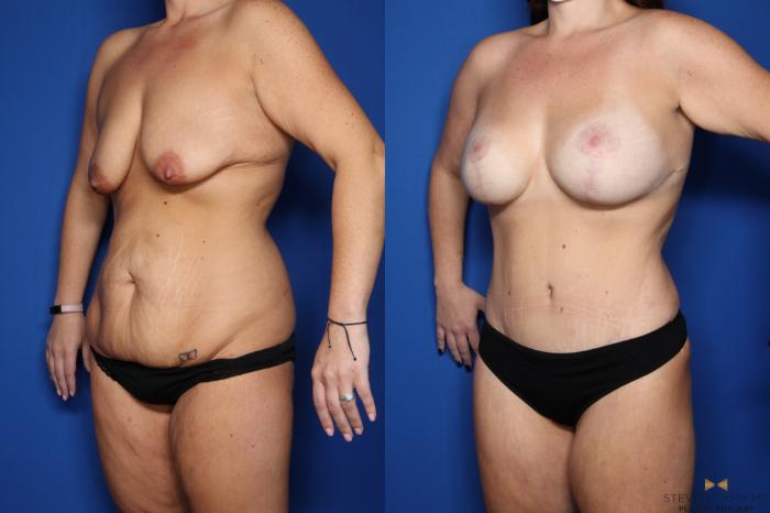 Before & After Mommy Makeover Case 438 Left Oblique View in Fort Worth & Arlington, Texas