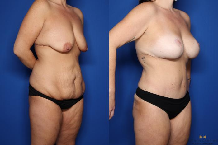 Before & After Tummy Tuck Case 438 Right Oblique View in Fort Worth & Arlington, Texas