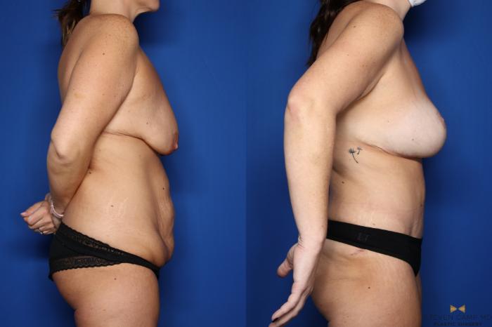Before & After Tummy Tuck Case 438 Right Side View in Fort Worth & Arlington, Texas