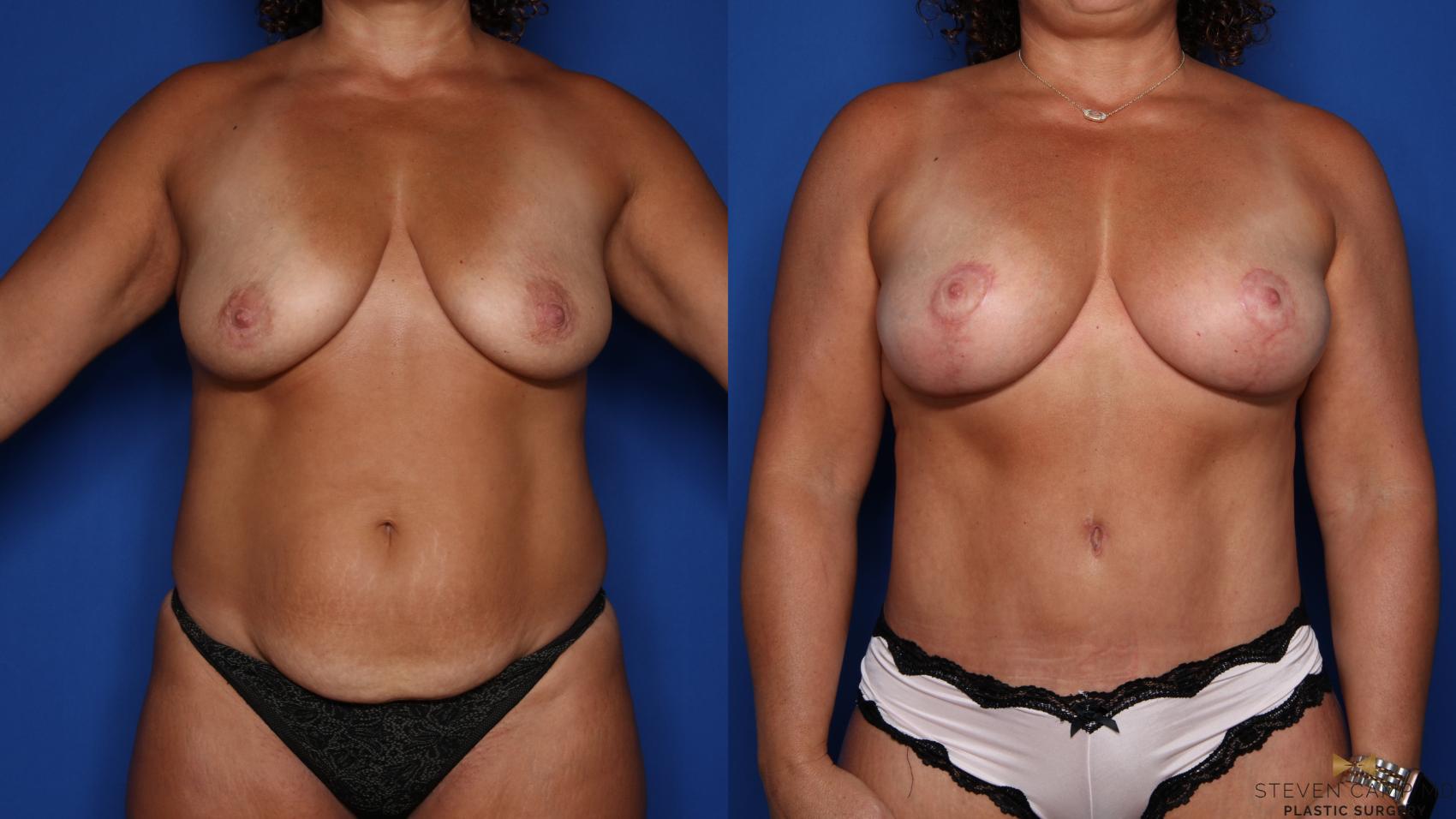 Before & After Breast Lift (Breast Mastopexy with Implants) Case 439 Front View in Fort Worth & Arlington, Texas