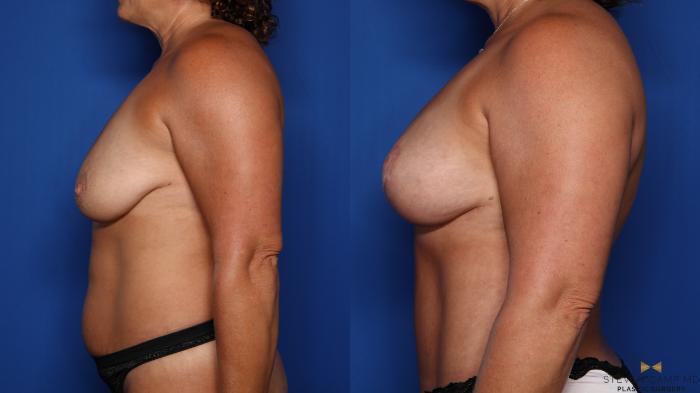 Before & After Breast Lift (Breast Mastopexy with Implants) Case 439 Left Side View in Fort Worth & Arlington, Texas