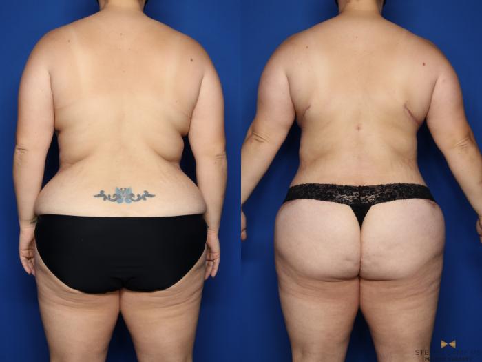 Before & After Liposuction Case 483 Back View in Fort Worth & Arlington, Texas