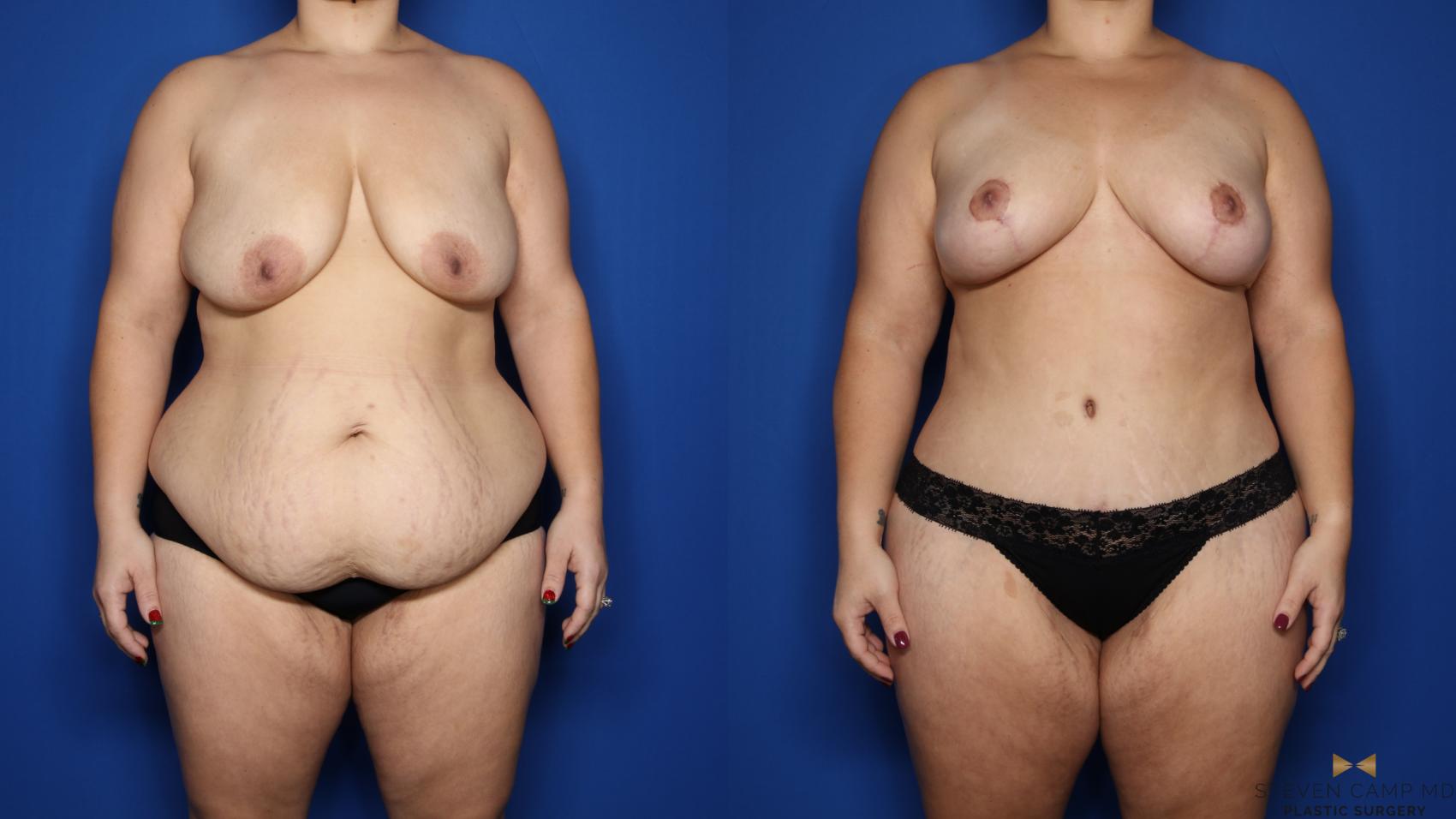 Before & After Renuvion Skin Tightening Case 483 Front View in Fort Worth & Arlington, Texas