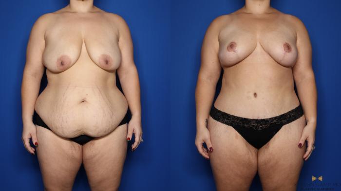 Before & After Liposuction Case 483 Front View in Fort Worth & Arlington, Texas