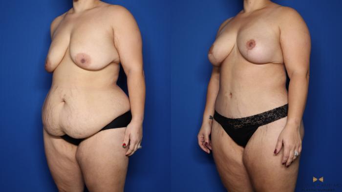 Before & After Liposuction Case 483 Left Oblique View in Fort Worth & Arlington, Texas
