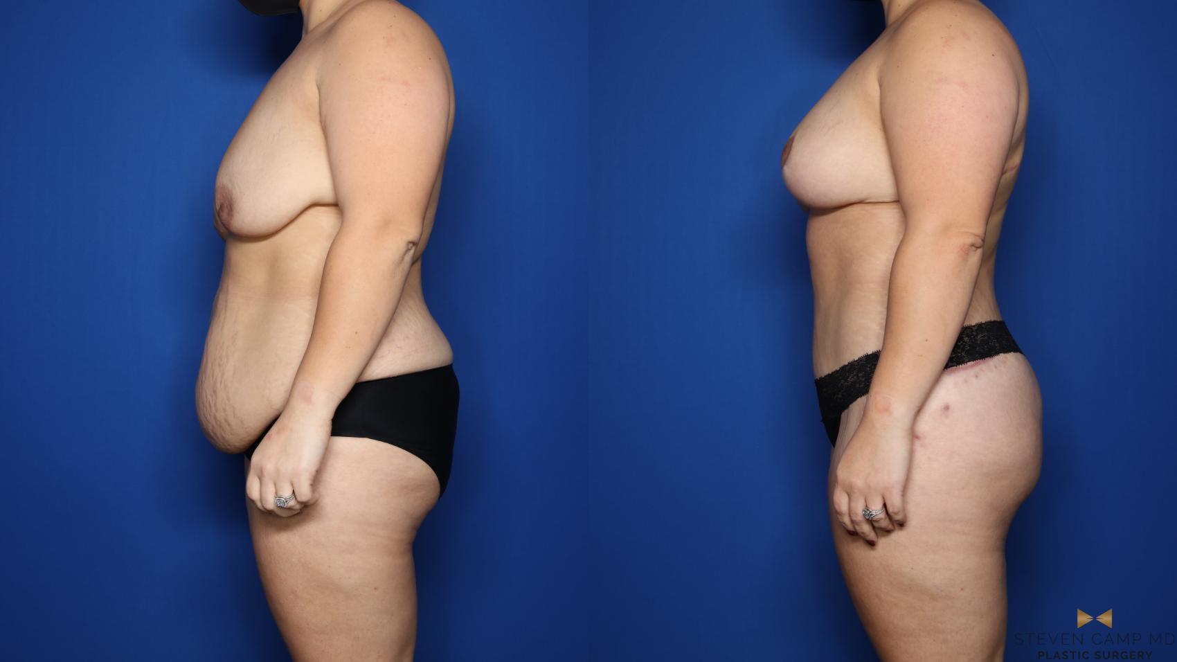 Before & After Renuvion Skin Tightening Case 483 Left Side View in Fort Worth & Arlington, Texas