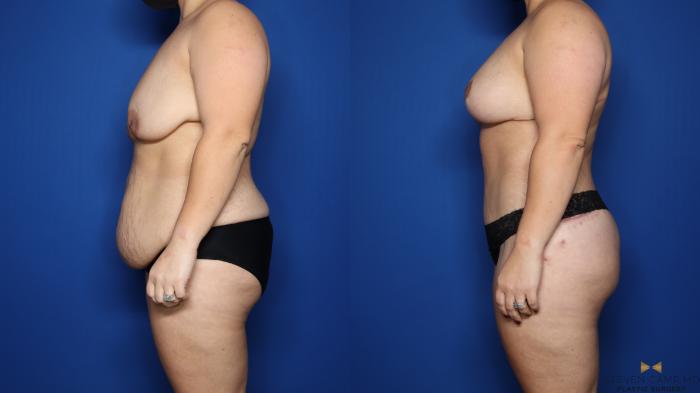 Before & After Liposuction Case 483 Left Side View in Fort Worth & Arlington, Texas