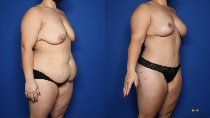 Before & After Tummy Tuck Case 483 Right Oblique View in Fort Worth & Arlington, Texas