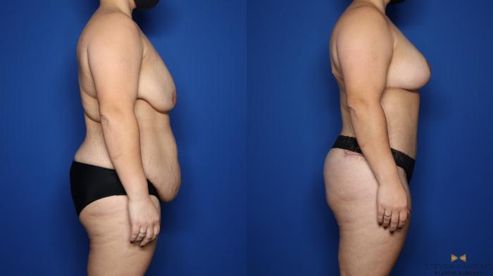 Before & After Liposuction Case 483 Right Side View in Fort Worth & Arlington, Texas