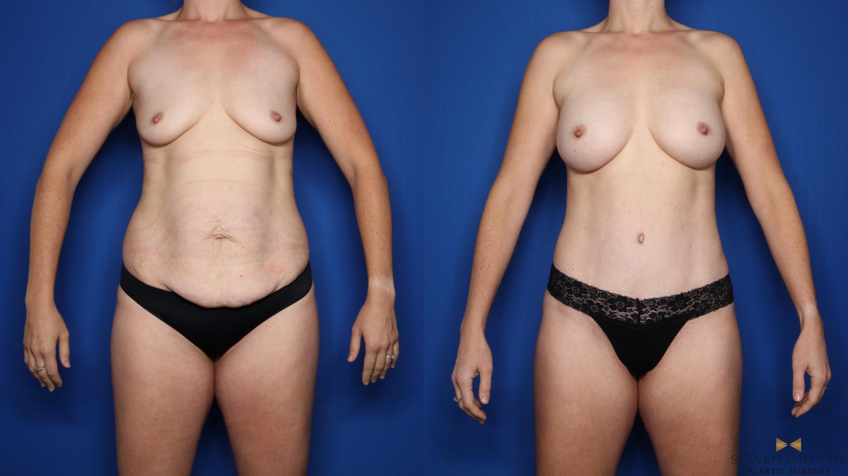 Before & After Tummy Tuck Case 507 Front View in Fort Worth, Texas