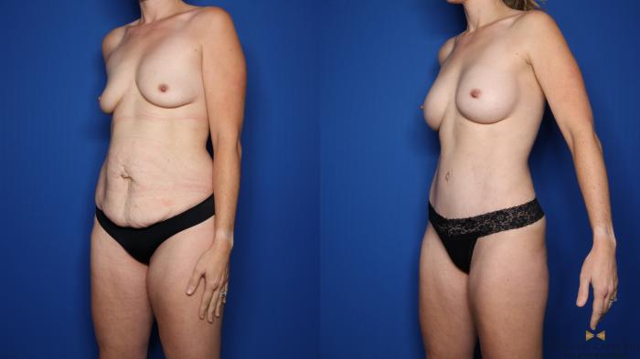 Before & After Tummy Tuck Case 507 Left Oblique View in Fort Worth & Arlington, Texas