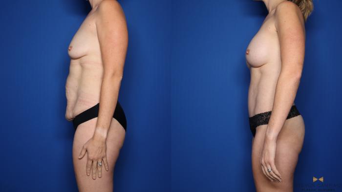 Before & After Breast Augmentation Case 507 Left Side View in Fort Worth, Texas