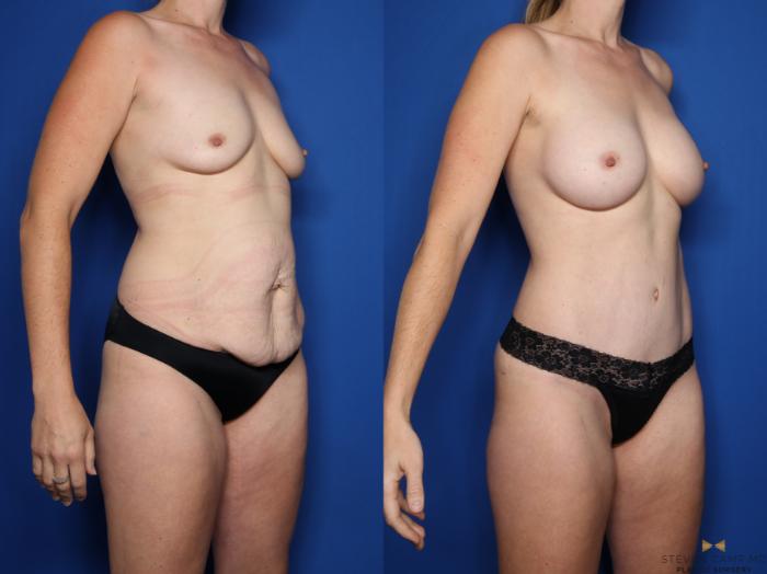 Before & After Tummy Tuck Case 507 Right Oblique View in Fort Worth & Arlington, Texas