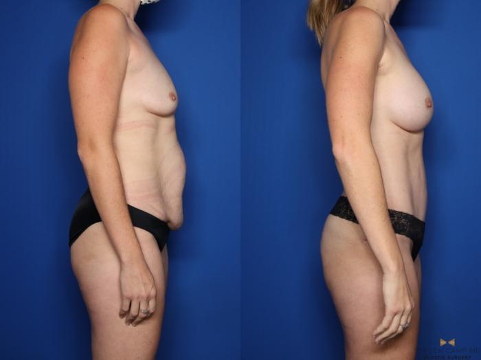 Before & After Tummy Tuck Case 507 Right Side View in Fort Worth & Arlington, Texas