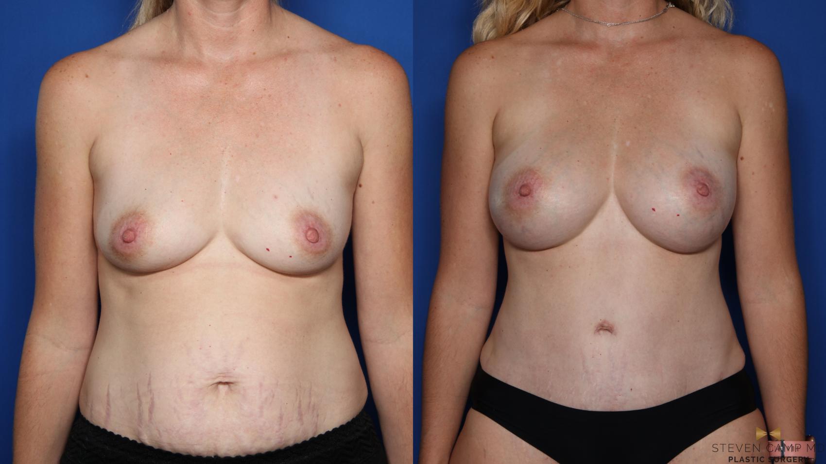 Before & After Mommy Makeover Case 516 Front View in Fort Worth & Arlington, Texas