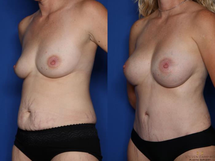Before & After Tummy Tuck Case 516 Left Oblique View in Fort Worth & Arlington, Texas