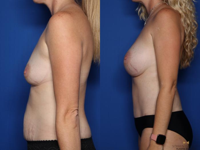 Before & After Mommy Makeover Case 516 Left Side View in Fort Worth & Arlington, Texas