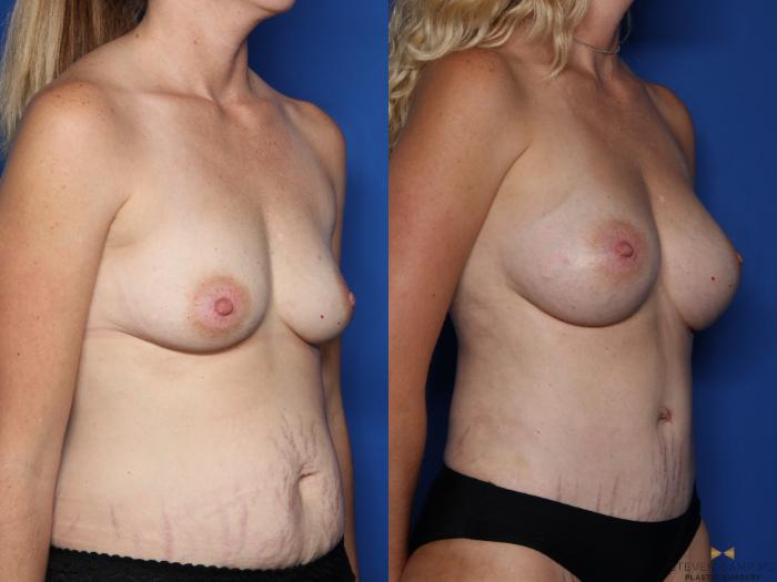 Before & After Tummy Tuck Case 516 Right Oblique View in Fort Worth & Arlington, Texas
