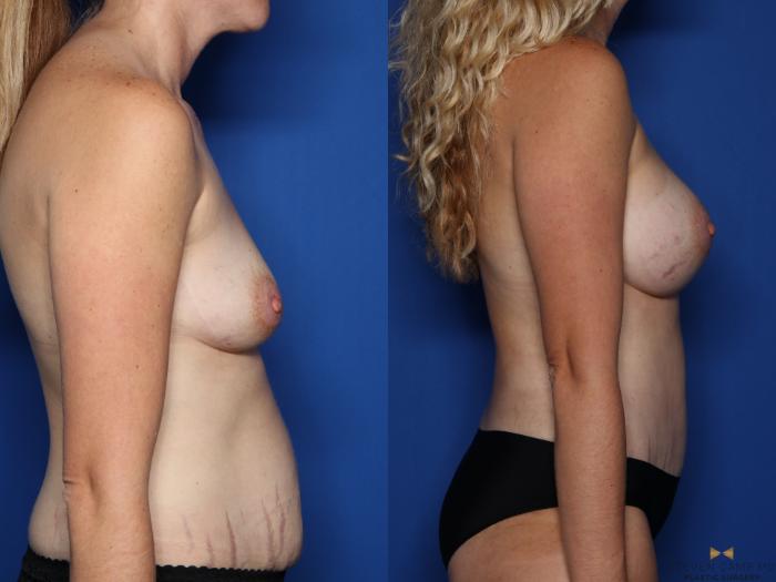 Before & After Tummy Tuck Case 516 Right Side View in Fort Worth & Arlington, Texas