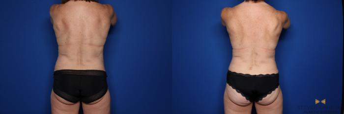 Before & After Liposuction Case 517 Back View in Fort Worth & Arlington, Texas