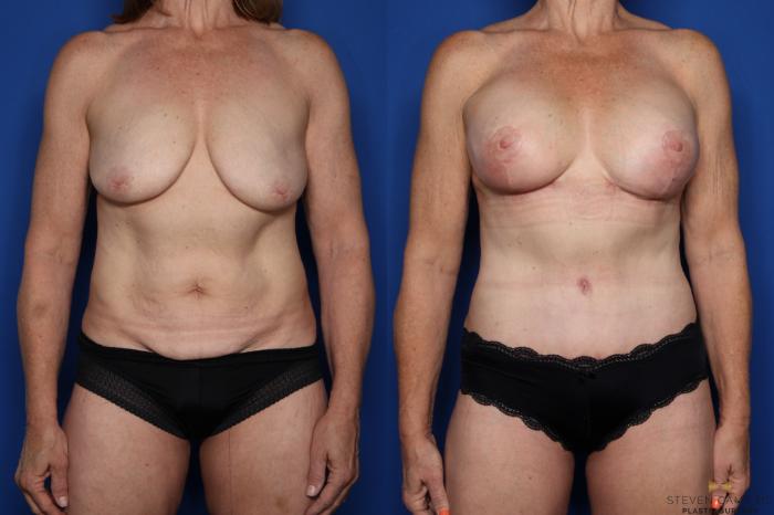 Before & After Breast Implant Exchange (Breast Revision) Case 517 Front View in Fort Worth & Arlington, Texas