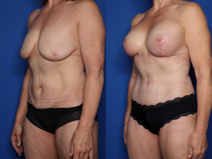 Before & After Liposuction Case 517 Left Oblique View in Fort Worth & Arlington, Texas