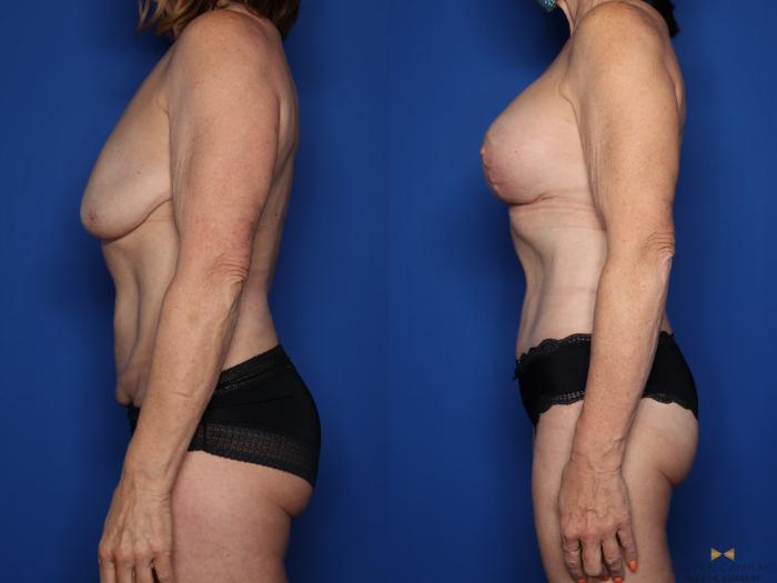 Before & After Liposuction Case 517 Left Side View in Fort Worth & Arlington, Texas