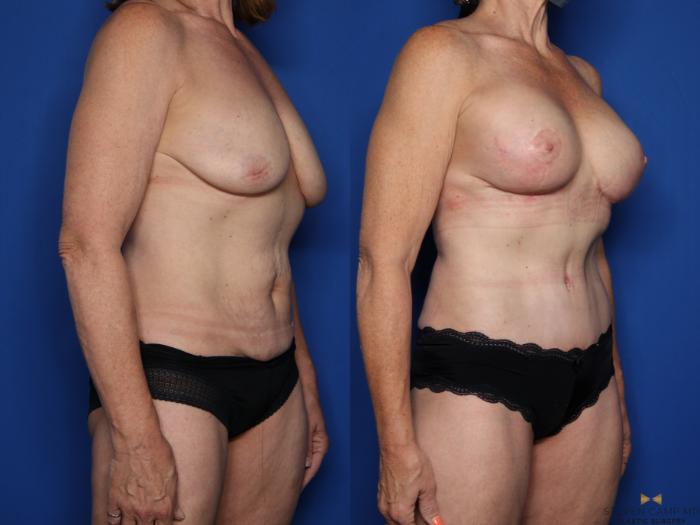 Before & After Breast Implant Exchange (Breast Revision) Case 517 Right Oblique View in Fort Worth & Arlington, Texas
