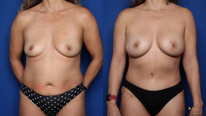 Before & After Tummy Tuck Case 518 Front View in Fort Worth & Arlington, Texas