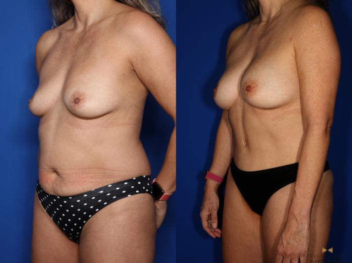 Before & After Tummy Tuck Case 518 Left Oblique View in Fort Worth & Arlington, Texas