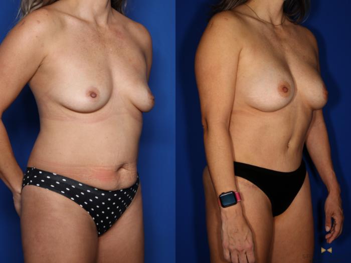 Before & After Breast Augmentation Case 518 Right Oblique View in Fort Worth & Arlington, Texas
