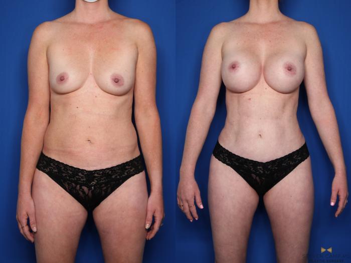 Before & After Renuvion Skin Tightening Case 519 Front View in Fort Worth & Arlington, Texas