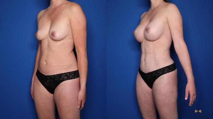 Before & After Renuvion Skin Tightening Case 519 Left Oblique View in Fort Worth & Arlington, Texas